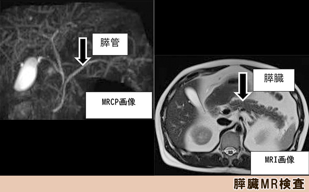 「膵臓MR検査」は、強力な磁場と電波を用いて体内の水素原子の情報を収集し、それをもとに画像化する検査です。