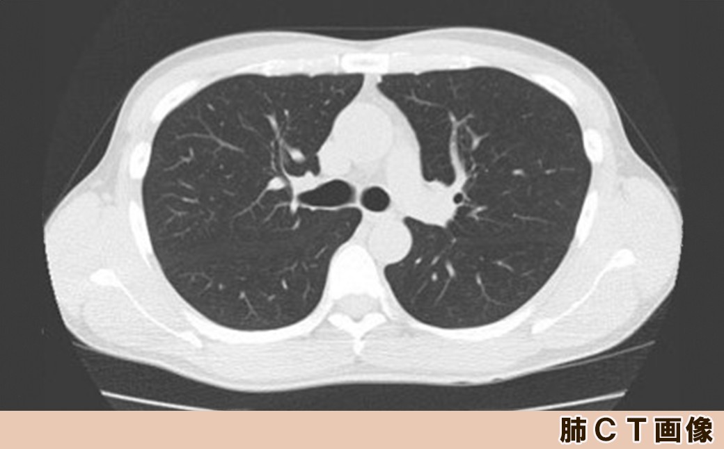 「肺CT検査」はCTを使用した詳しいX線検査です。胸部X線検査だけでは発見が困難な、早期の小さな肺がんの発見を目指します。